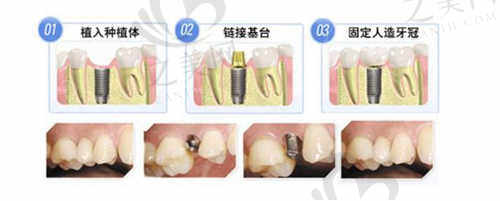 无锡维乐口腔医院种植过程