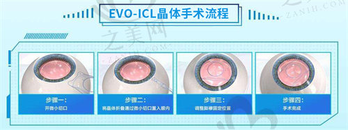 哈尔滨云海眼科医院做ICL晶体植入手术怎么样？