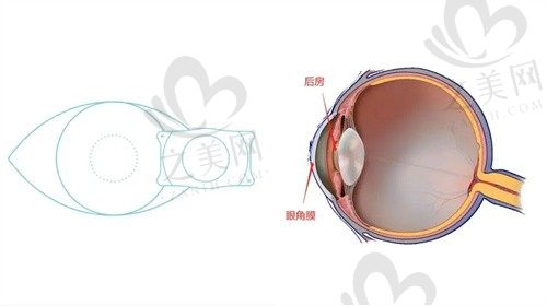 哈尔滨云海眼科ICL晶体植入术价格21960元起 ，散光/高度近视选择
