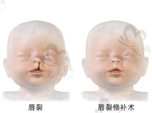 广州高尚医疗门诊部做唇裂修复好不好?好,找余文林医生准没错