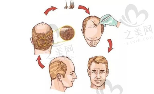 北京碧蓮盛植發(fā)主力醫(yī)生 北京碧蓮盛植發(fā)主力醫(yī)生