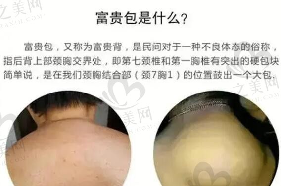 国内富贵包消除口碑医院名单:专治富贵包医院可以微创一次性消除富贵包