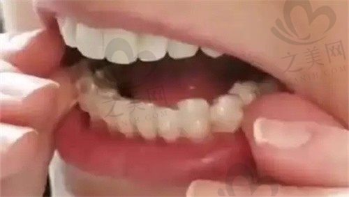 上海亿大口腔牙齿矫正价格表丨隐适美/时代天使/陶瓷矫正一览