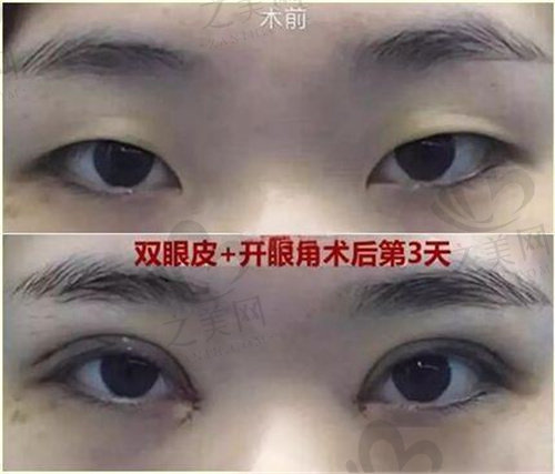 李春富双眼皮<span style= 李春富双眼皮<span style=