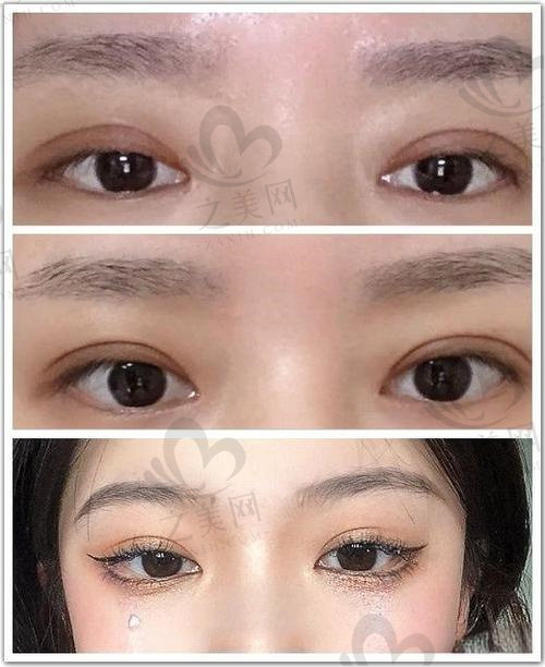 李春富双眼皮修复<span style= 李春富双眼皮修复<span style=