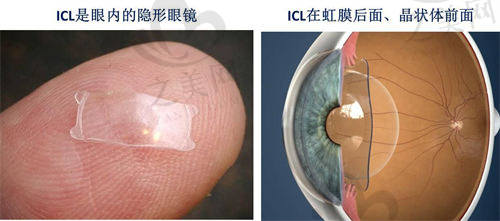 重庆丰都亚太眼科医院ICL晶体植入演示
