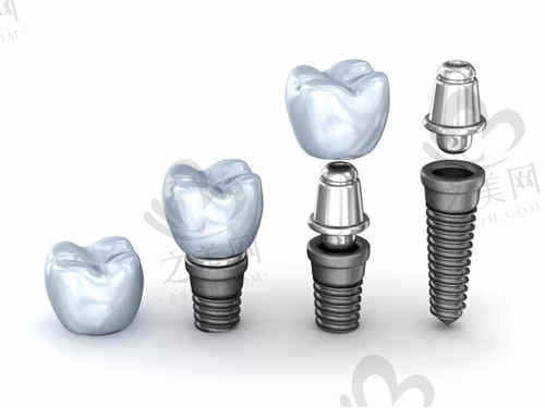 郑州德韩口腔种植牙价格表