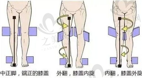 韩国波轮美整形小腿阻断价格2W起,腿变得又直又细可维持5年以上