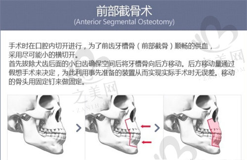 韩国EverM爱宝整形医院前部截骨