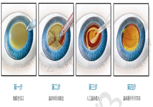 北京白内障手术图