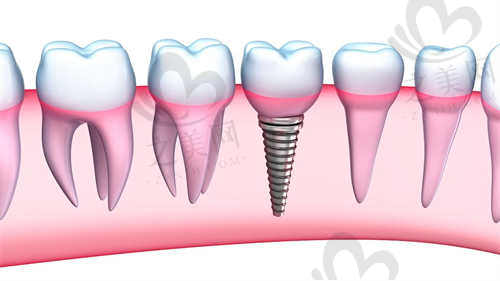 杭州牙科医院丽水口腔分院种植牙