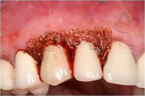 种植牙失败导致牙龈增生
