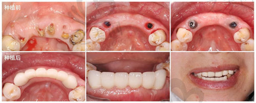 正常的种植牙前后对比