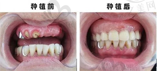 上海鼎植口腔医院高振华种植牙<span style=