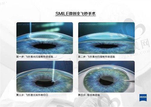 贵阳佰视佳眼科医院近视手术价格贵吗,不贵,飞秒仅需8000起,可在线预约