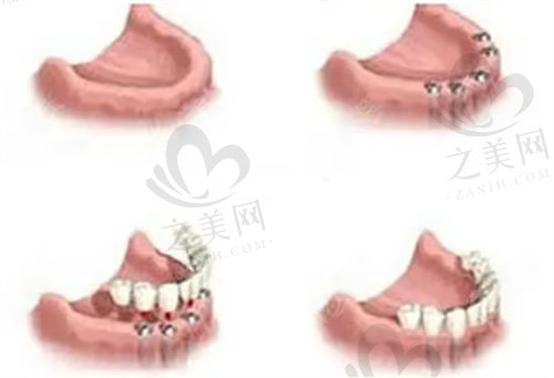 江南SMILE VIEW牙科种植牙