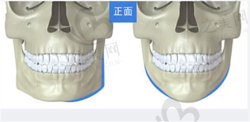 韩国Faceline菲斯莱茵凸嘴矫正