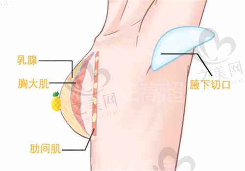 台州维多利亚整形医院隆胸.jpg