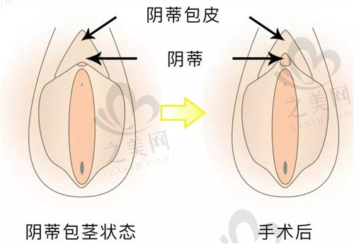 韩国好手艺阴唇整形