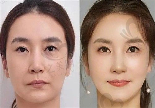 哈尔滨紫熙医疗美容医院李明哲全面部抗衰价格19800元起，打造冻龄美颜