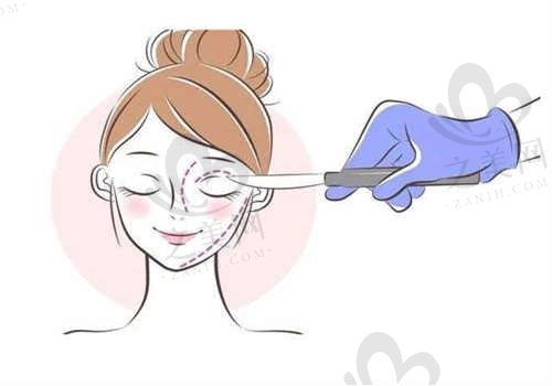 马鞍山福华医疗美容医院苏成胜院长做外切眼袋手术价格4800元起，附优势分析及口碑