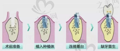 东莞长安泰康拜博口腔魏世亮医生iti种植6980元起/颗很划算