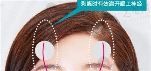 韩国优雅人额头缩小1080w韩元起,朴哲佑亲诊剥离精细疤痕小