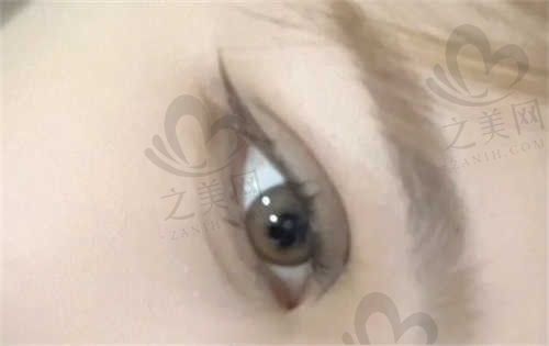 哈尔滨超龙医疗美容医院双眼皮价格贵吗?4000元起医生技术好口碑佳!