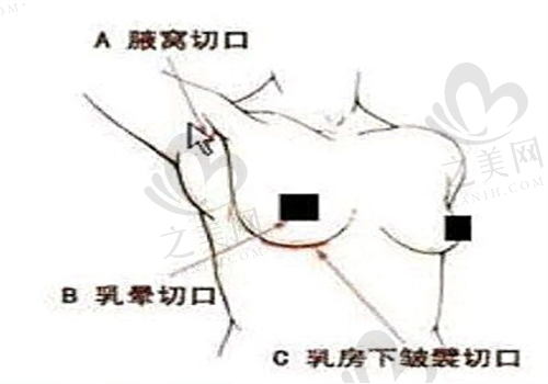 合肥艺星医疗美容医院缩胸手术