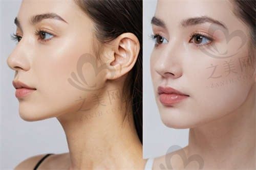 成都星美宝岛整形医院潘河LT人中缩短术价格18800元起，术后无痕非常自然