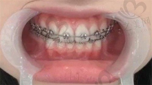 石狮牙齿矫正哪家医院好?分享我在星雅口腔谢柳萍医生那里的矫正经历!