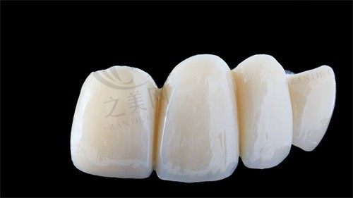 重庆泰康拜博口腔邹孟韩做瑞士义获嘉全瓷牙贴面3500起，自然美观