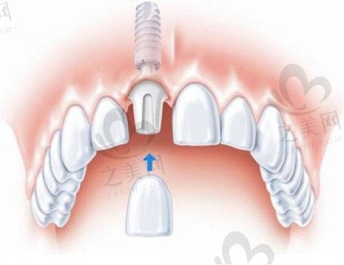 重庆牙博士口腔医院李荣韩国进口种植牙2500元起,主打性价比,做过的都说好