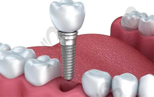 重庆德亚口腔医院种植牙多少钱