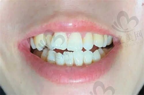 杭州臻吻口腔医院种植牙怎么样?技术先进、医生经验丰富!