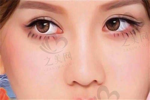 邯郸莱媚俪医疗美容医院曹云雷祛眼袋3000元起，微创无痕效果还自然！