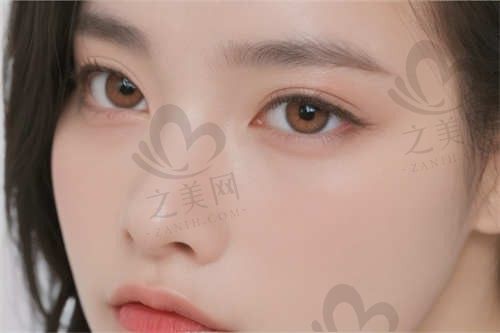 我在邯郸莱媚俪做了眼睑下垂矫正,非常感谢曹云雷医生,术后恢复很好