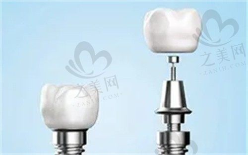 重庆德亚口腔门诊部德国ICX种植牙7000元/颗起,李定成医生技术娴熟