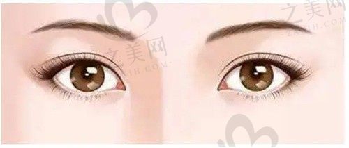 北京客来美舍医疗美容门诊部张冰洁双眼皮修复36000元起，修复双眼皮瑕疵