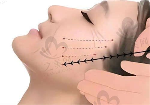 大连悦容医疗美容赵凤霞做线雕提升8000元起，患者口碑评分高！