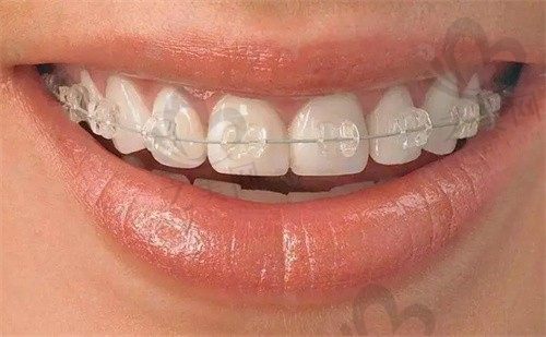 武汉皓诺口腔门诊部杨艳医生陶瓷半隐形矫正4999元起，医生专业技术精湛