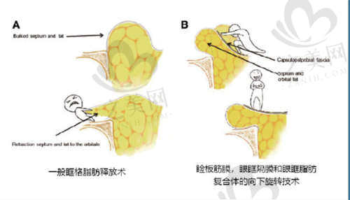 黄震英医生CSFC翻转眼袋术优势