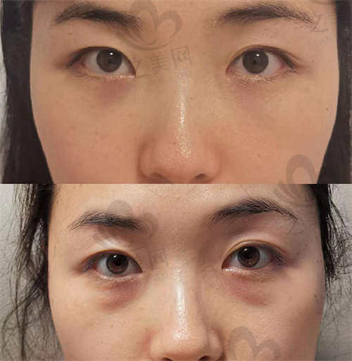 眼袋祛除手术前后的变化