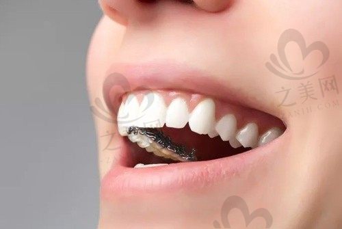 我在武汉皓诺口腔做了舌侧矫正,医生矫正技术没的说,成效超赞