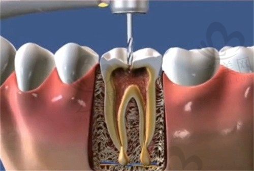 深圳博爱曙光医院口腔科钟春根根管治疗580元起，解决牙痛困扰