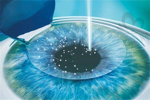 宿州润视眼科杨德胜医生个性化飞秒近手术价格13600元起,重塑清晰视界