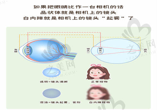 北京朝聚眼科医院赵阳医生飞白三焦点晶体手术价格表