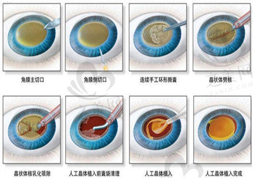 如何预约北京朝聚眼科医院赵阳医生？