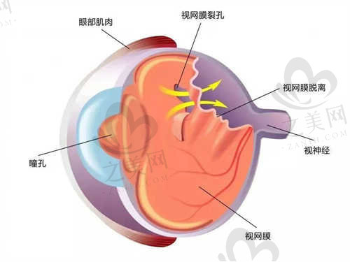 锦州何氏眼科医院全飞秒激光近视手术流程