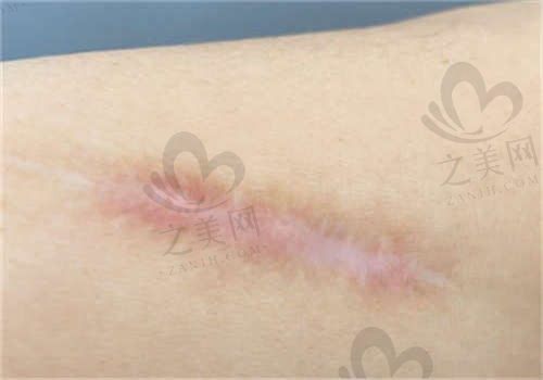 长沙长海整形医院张静兰疤痕修复500元起，可修复增生性/凹陷性/剖腹等疤痕